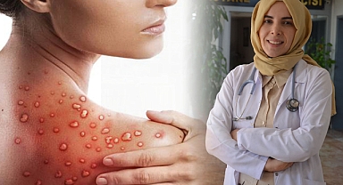 Urfa’da Görevli Uzman Uyardı! Maymun Çiçeği’nden Korunmanın Yolları