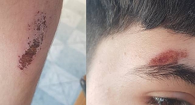 Urfa'da Sokak Köpeklerinden Kaçan Çocuk Düşerek Yaralandı