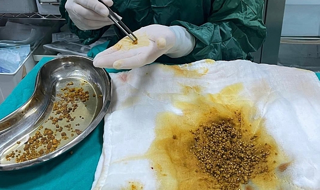 Doktorlar Hayrete Düştü Safra Kesesinden 2 Bin 67 Taş Çıktı!